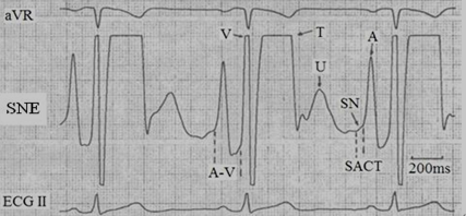 典型的窦房结电图